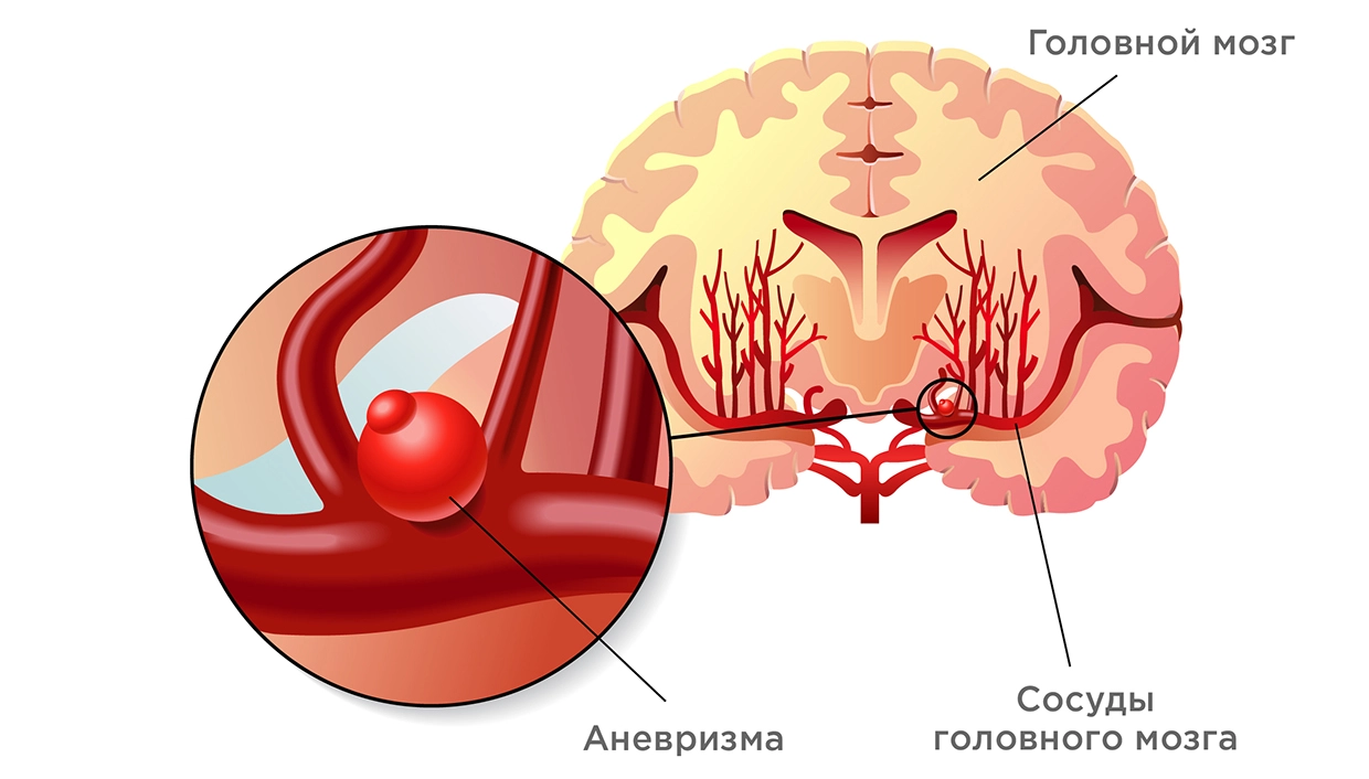 Аневризма сосудов головного мозга - причины, виды и лечение